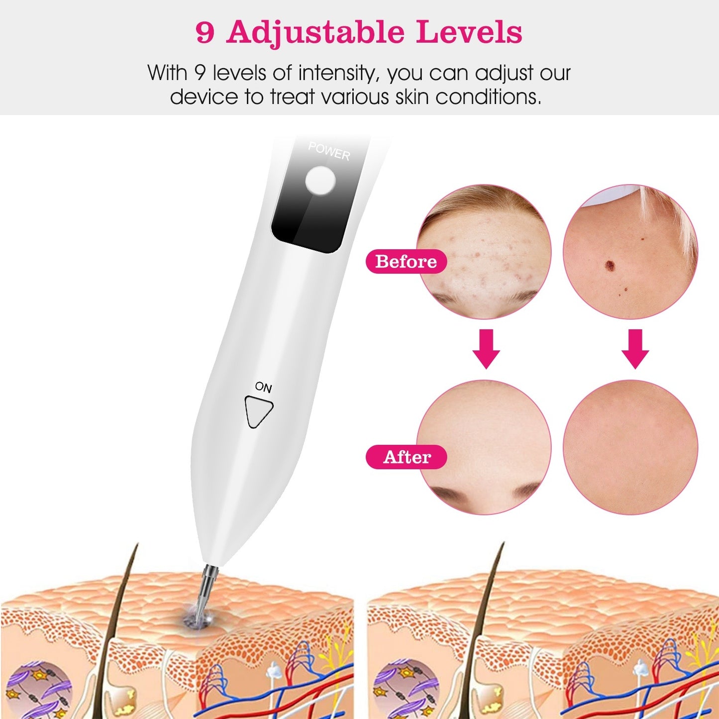 Skin Tag Repair Kit Portable Beauty Equipment Multi-Level With Home Usage USB Charging LCD Level Adjustable 6 Replaceable Needles
