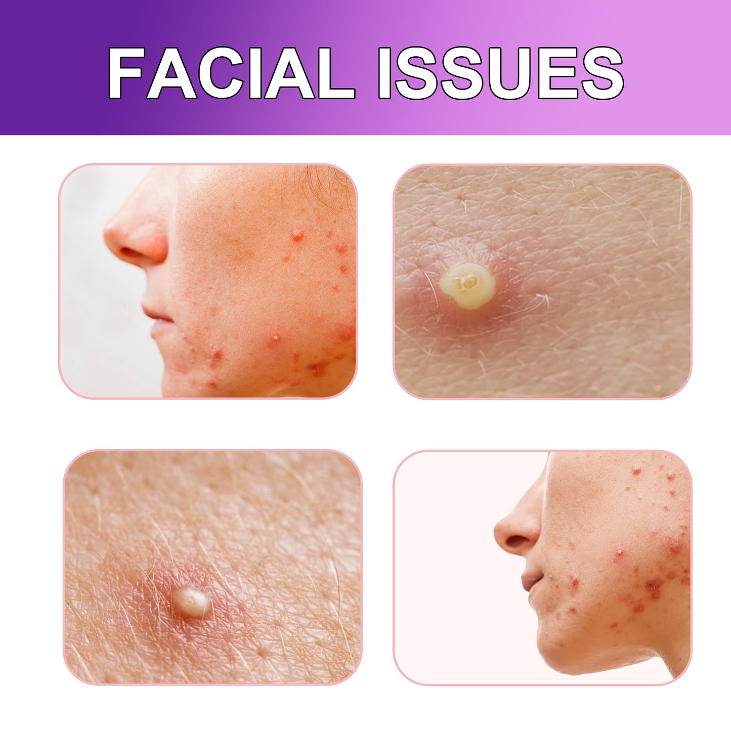 Diminish Facial Acne And Pimple Patches